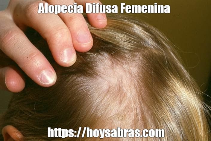 alopecia difusa femenina